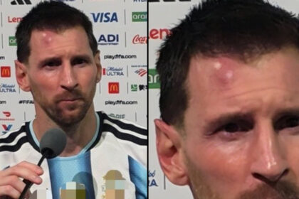 Side-by-side photos of a male athlete being interviewed; left shows him speaking into a microphone in front of sponsor logos, right is a close-up of his face with a blemish/bruise.